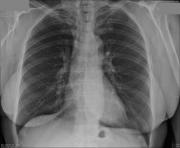 radiographie thorax