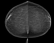 mammographie-image